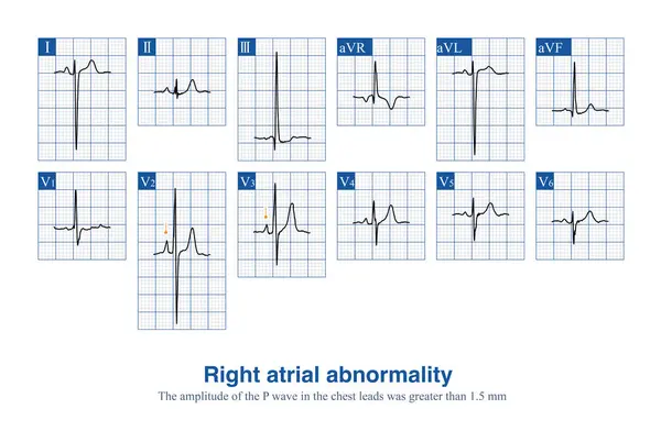 stock image Male, 10 years old, was clinically diagnosed with tetralogy of Fallot. ECG shows an elevated P wave amplitude in thoracic leads, suggesting right atrial abnormality.