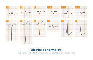 ECG kağıdı aslında kayıt için kullanılan bir koordinat kağıdıdır, kenar uzunluğu 1 mm olan küçük kareler, yatay ve genliği dikey olarak temsil eder..