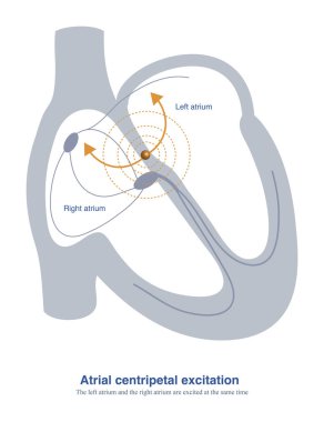 When ectopic focal areas in the atria are located in the atrial septum, the left atrium and right atrium can be excited at the same time, producing a very narrow P wave. clipart