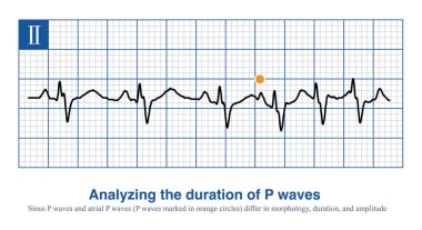 When intraatrial excitation is transmitted from one atrium to the other, a wider duration of P waves are generated, such as sinus rhythm, lateral  left atrial focal, etc. clipart