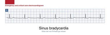 Erkek, 71 yaşında, klinik olarak üst gastrointestinal kanama teşhisi konmuş. Geceleri uyurken, EKG monitöründe sinüs bradikardisi, kan basıncı 115 ve 70 mmHg görüldü..
