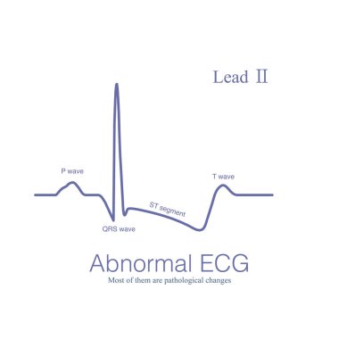 Anormal EKG depolarizasyon dalgaları ve kutuplaşma dalgaları anlamına gelir, bunların çoğu patolojik ve çok azı fizyolojik.