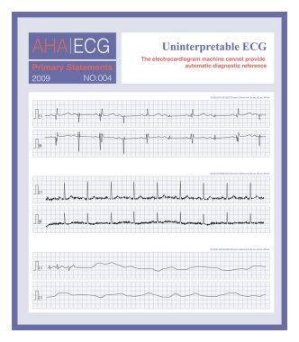 ECG çok karmaşık olduğunda, kayıt kalitesi düşüktür, ya da ECG 'nin kaybına neyin sebep olduğunu yorumlamak imkansızdır, ECG makinesi tanısal bir referans sağlayamaz..
