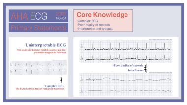 ECG çok karmaşık olduğunda, kayıt kalitesi düşüktür, ya da ECG 'nin kaybına neyin sebep olduğunu yorumlamak imkansızdır, ECG makinesi tanısal bir referans sağlayamaz..