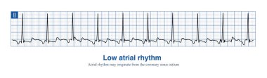 When the rhythm of the atria originates in the lower part of the atria, the whole atria are excited from inferior to superior, producing negative P waves in the inferior leads. clipart