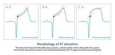 According to the offset amplitude of the ST segment at J point and J60 point, ST segment elevation can be divided into three basic types: concave upward, oblique straight and concave downward type. clipart