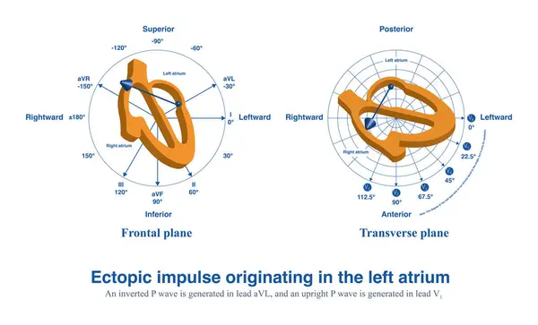 Ectopic Impulses Originate Left Atrium Upright Wave Generated Inverted Wave — Stock Photo, Image
