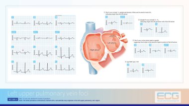 Atrial odak noktası sol üst pulmoner damarda, V1 'de dik bir P dalgası ve geniş bir zaman dilimi ile, kurşun aVL' de ters P dalgası ve alt uçlarda çentik olan dik bir P dalgası..