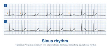 Sometimes, the P wave amplitude of sinus rhythm is so low that it is close to an isopotential and can easily be mistaken for a borderline rhythm. clipart