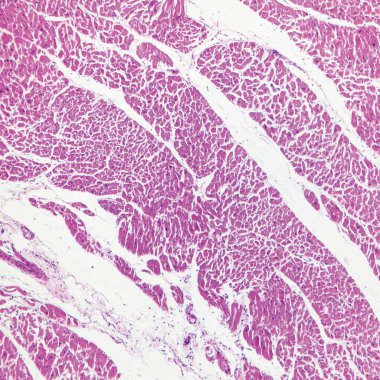 Bu, insan sol ventriküler hipertrofinin patolojik bir fotoğrafı. Miyokardiyal çapta ve inançlar arası mesafede artış var. 40x büyüt..