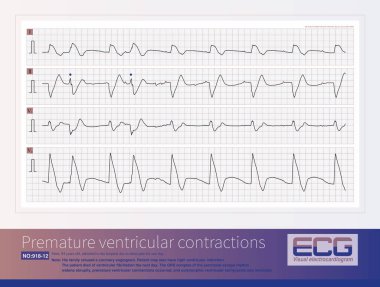 A patient with AIMI presents with a sudden widening of the QRS complex in the junctional escape rhythm, premature ventricular contractions, resulting in  polymorphic ventricular tachycardia. clipart