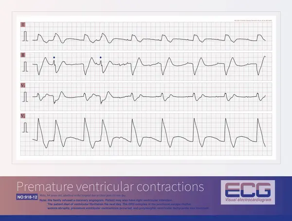 stock image A patient with AIMI presents with a sudden widening of the QRS complex in the junctional escape rhythm, premature ventricular contractions, resulting in  polymorphic ventricular tachycardia.