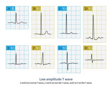 ST-segment uzunluğu ve T dalgası simetrisi ve yüksek EKG ipuçları hipokalsemi ve hiperkalemi olduğunu gösteriyor..