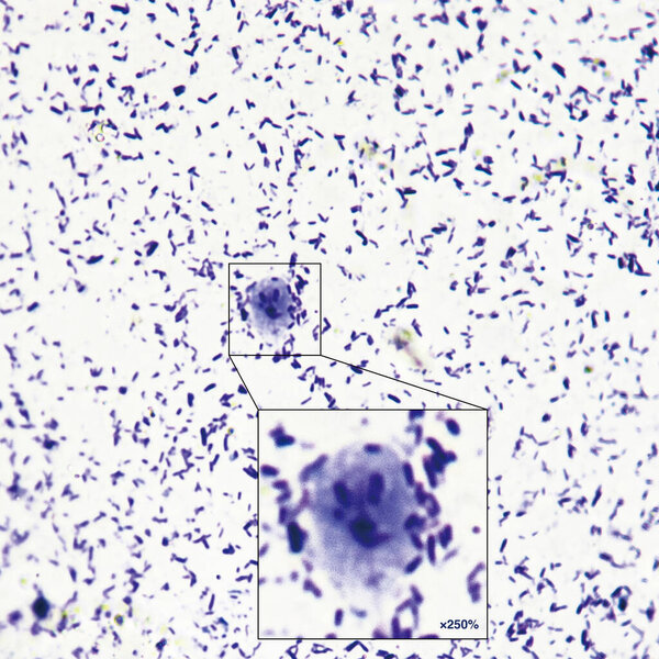 Джардия - паразитарное заболевание, вызванное двенадцатиперстной кишкой Джардии. Пациенты имеют диарею, боль в животе и потерю веса. Увеличьте 400x.