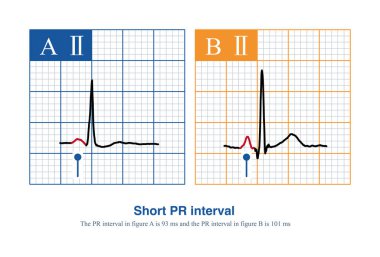 Yetişkin bir ECG 'nin halkla ilişkiler aralığı 120 m' den azdır, buna kısa PR aralığı denir..