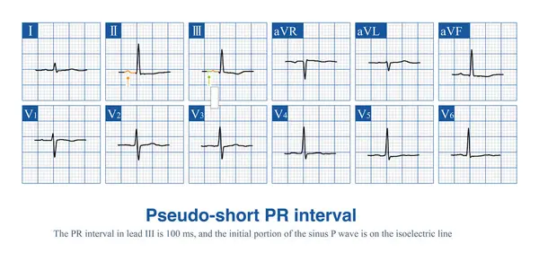 stock image Sometimes, the beginning of sinus P wave in some ECG leads is located on the isoelectric line. If only the visualization part is measured, it will produce a pseudo short PR interval.