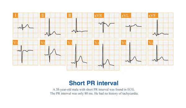 stock image The PR interval of an adult ECG is less than 120 ms, which is called a short PR interval.