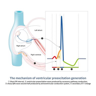 Ventricular preexcitation is a fusion wave formed by the accessory pathway and normal atrioventricular conduction system exciting a part of ventricle respectively. clipart