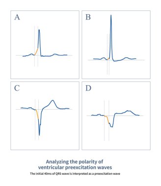  Ventriküler önleme dalgalarının polaritesi, Şekil A ve B 'de ya da Şekil C ve D' de gösterildiği gibi, pozitif olabilir..