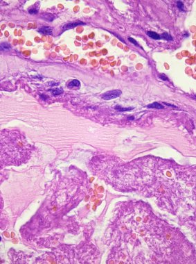 This photo shows the pink mucinous matrix of atrial myxoma, myxoma cells arranged in nests and cords, and local bleeding.Magnify 1000x. clipart