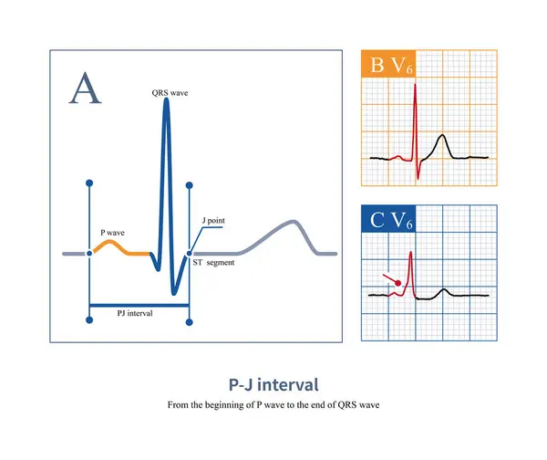 stock image On the electrocardiogram, the PJ interval is used to distinguish between ventricular heartbeats and ventricular pre excitation. The normal value of PJ interval is less than 270ms.