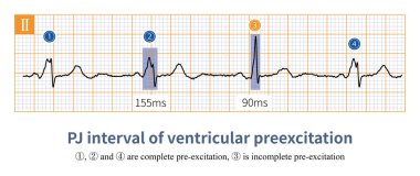 When ventricular preexcitation components occupy different proportions of QRS waves, the measured PJ intervals are different. clipart