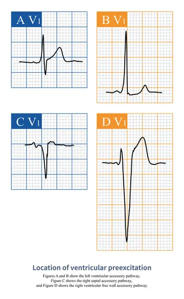 stock image On the electrocardiogram, observing the morphology of QRS waves in lead V1 can distinguish whether ventricular pre excitation is located in the left ventricle or the right ventricle.