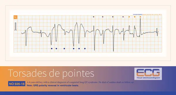 stock image A 4-year-old boy with a clinical diagnosis of long QT syndrome. No genetic testing was done during hospitalization. The child died suddenly during follow-up.