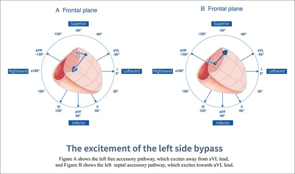 stock image When the left free wall and septal accessory pathway are excited, preexcitation waves with different polarities are generated in leads  and aVL.