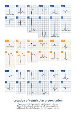 Elektrokardiyogramda, kurşun V1 'deki QRS dalgalarının morfolojisini gözlemlemek ventriküler uyarılmanın sol karıncıkta mı yoksa sağ karıncıkta mı olduğunu ayırt edebilir..