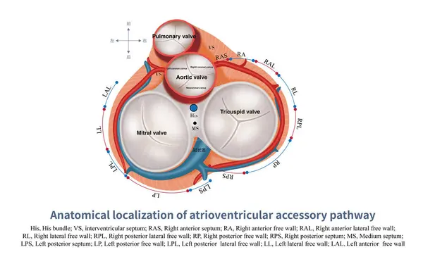 stock image Surrounding the atrioventricular ring, except for the anterior septum of the left ventricle, there is no distribution of accessory pathways, and accessory pathways can exist in other parts.