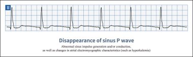 EKG 'deki sinüs P dalgası kaybolduğunda, bu anormal bir jenerasyon ve / veya sinüs dürtülerinin iletkenliğinden olabilir, ya da atriyal kas lezyonlarından kaynaklanabilir..