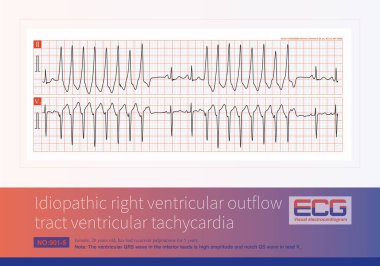 Ventricular tachycardia originating from the right ventricular outflow tract can be sustained or short-burst, and is a benign idiopathic ventricular tachycardia. clipart