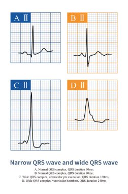 Narrow QRS wave and wide QRS wave clipart