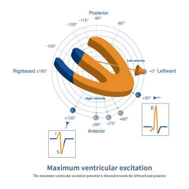 Sol ventrikülün büyük kütlesi nedeniyle, sol ve sağ ventriküllerin baskın uyarılma potansiyelleri sol ventriküle doğru yöneliktir. Soldan, aşağıdan, aşağıdan....