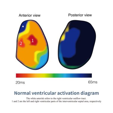 During normal ventricular excitation, the earliest epicardial breakthrough point is located in the paraventricular septal area, and the RV outflow tract and the base of the LV are finally excited. clipart