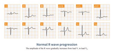 Normal şartlar altında, göğüs kurşun elektrokardiyogramında R dalgasının genişliği V1 'den V6' ya kademeli olarak artar..