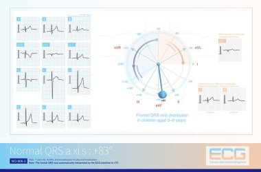 Ön QRS ekseni + 83 olduğunda, kurşun aVF 'nin R genliği en yüksektir. Ön QRS ekseni kurşun eksenine neredeyse diktir. .