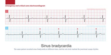 When sinus bradycardia is obvious, the ventricle can be controlled by junctional escape and ventricular escape, and escape rhythm appears. clipart