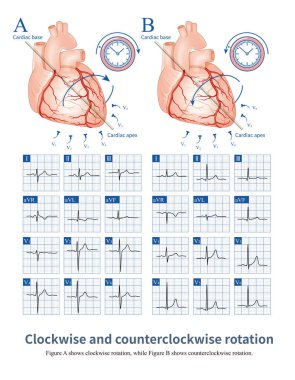 Clockwise and counterclockwise rotation are common electrocardiographic phenomena, mainly used to describe the evolution of R-wave amplitude in chest leads. clipart