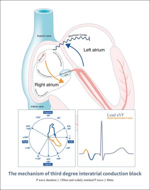 Bachmann bohça iletimi kesildiğinde, sağ atriyum sol atriyumu koroner sinüs boyunca uyarır, alt tarafta pozitif ve negatif bifazik P-dalgaları oluşturur..
