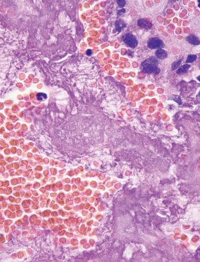 Bu fotoğraf atriyal miksomun pembe miksomu gösteriyor. Miksoma hücreleri ve alyuvarların odak kanamaları var. 1000x büyüt..