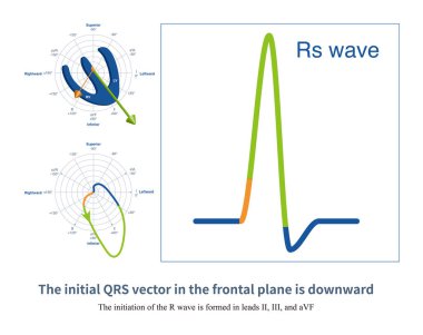 Ön düzlem kurşun sisteminde, QRS dalgasının ilk vektörü aşağı doğru yönelirken, pozitif QRS dalgası II, III ve AVF yönlerinde kaydedilmiştir..