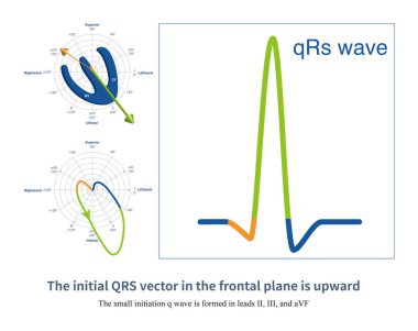 Ön kurşun sisteminde, QRS dalgasının ilk vektörü yukarı doğru işaret ettiğinde, II, III ve AVF negatif bir QRS dalgası, yani küçük bir q dalgası kaydeder..