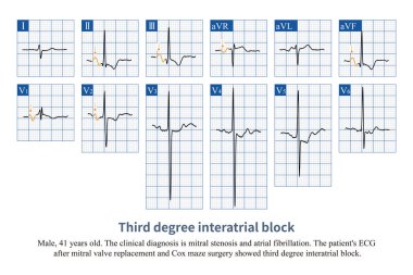 When Bachmann bundle conduction is interrupted, the right atrium excites the left atrium through the coronary sinus, producing positive and negative biphasic P-waves in the inferior leads. clipart