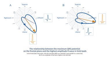 Ön düzlem kurşun sisteminde, maksimum QRS dalga potansiyeli belirli bir kurşuna daha paralel olduğunda, bu kurşunun R dalgası genliği uzuv kurşununda en yüksektir..