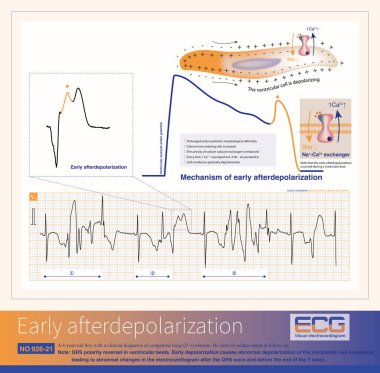 Erken depolarizasyon, T dalgasının sonundan önce meydana gelen ve genellikle QT aralığında görülen bir aritmojenik mekanizmadır.. 