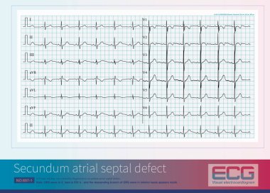 When QRS wave is multi-component in V1 lead and notch appears in inferior lead, it is highly suggested that the subject may suffer from atrial septal defect. clipart