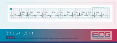 Sinüs ritminin arka planında, eğer P-P aralığı 120 metreden az ise, ritmin düzenli olduğu ve sinüs aritmisi olarak teşhis edilemediği düşünülebilir..