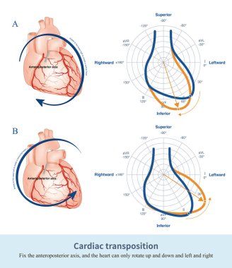 Kalp anteropterior eksen etrafında döndüğü zaman kalp sadece yukarı, aşağı, sola ve sağa sallanabilir. Bu da uzuvların EKG dalgalanmasını etkiler..